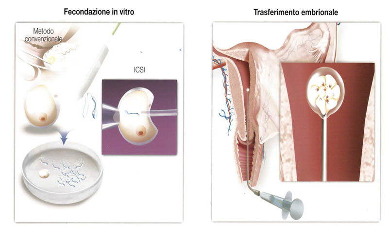 Fecondazione in vitro ed embryo-transfer